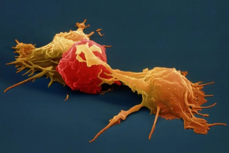 العلاج بالخلايا الجذعية للسرطان باستخدام الخلايا القاتلة الطبيعية