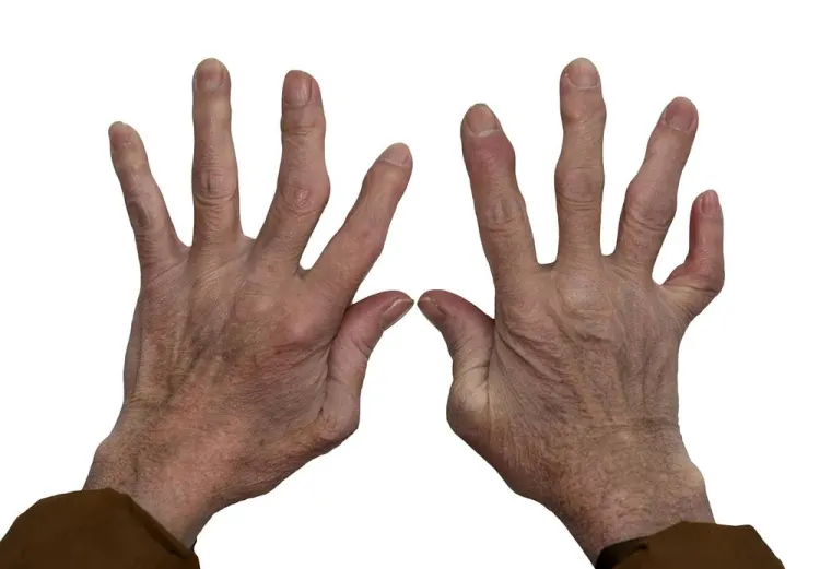 Systemic Sclerosis (Scleroderma) Icon